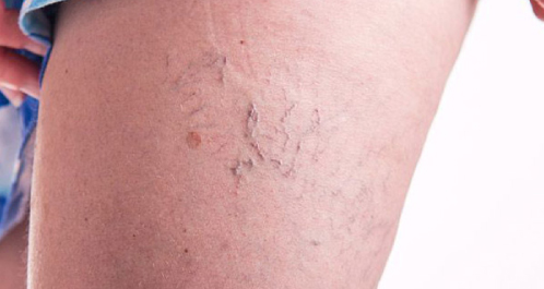 escleroterapia